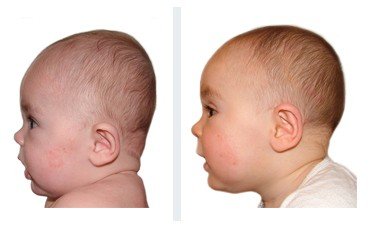 plagiocefalia bambini