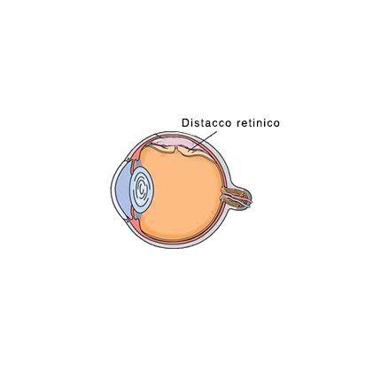 Distacco retinico